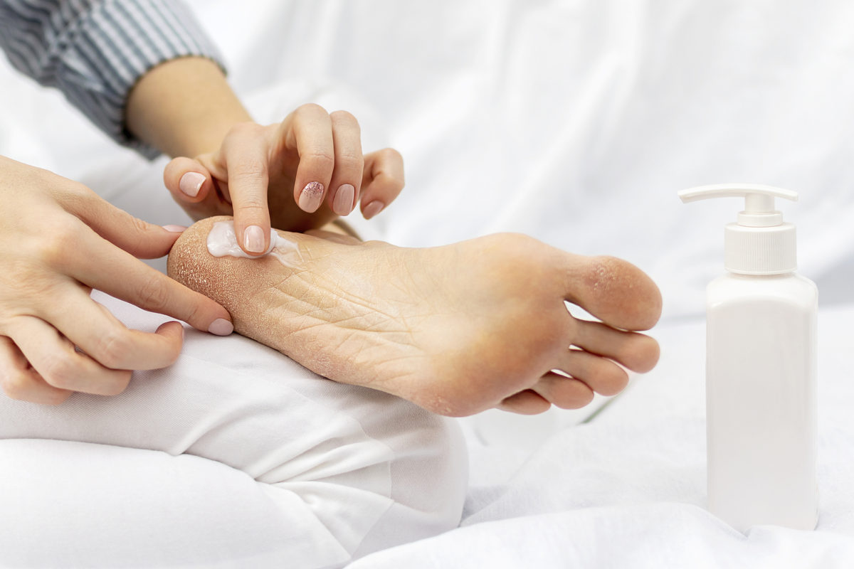 woman applying cream to her foot for warts