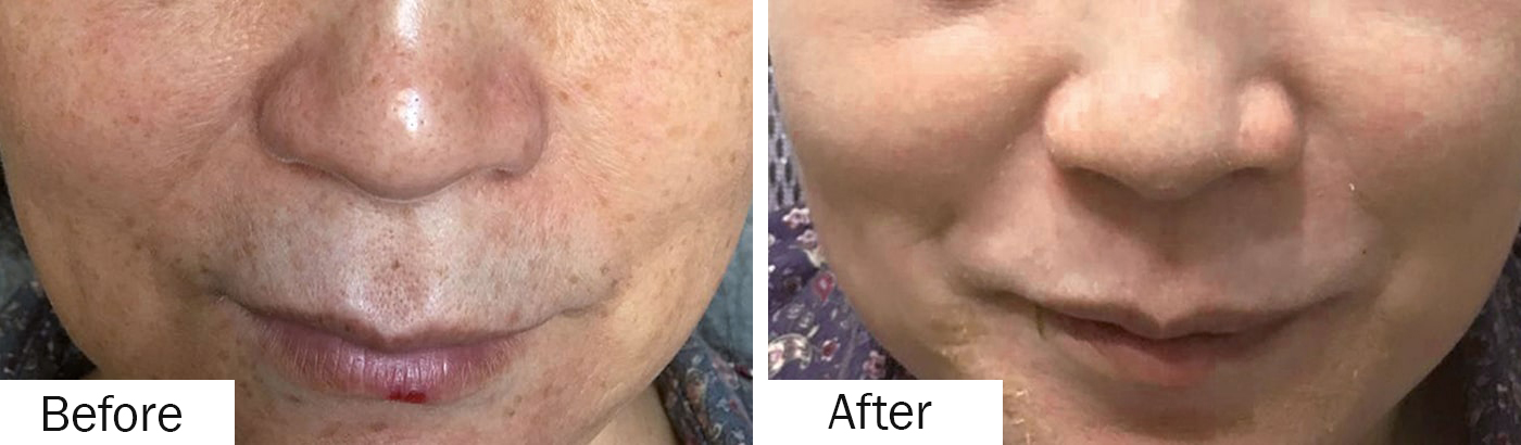 before and after melasma kit